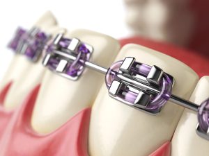 Types of braces