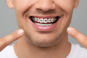 Adult braces